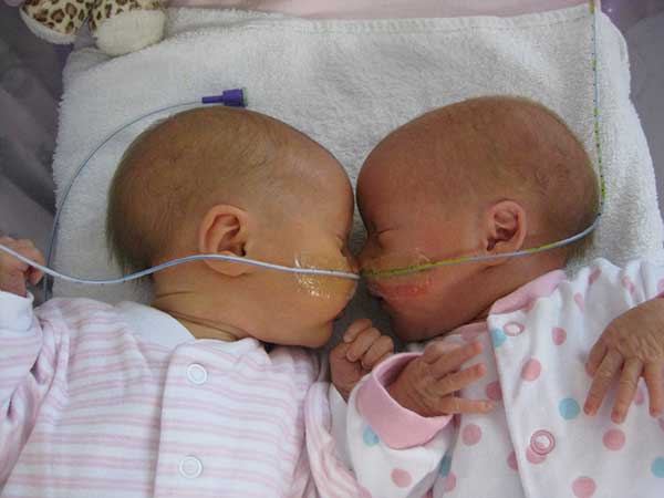 Premature twins supported by Tamba